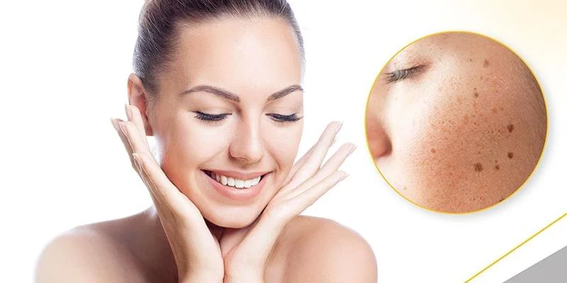 Pigmentation Reduction Treatment in Wagholi Pune